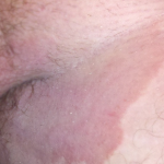Liesschimmel (tinea cruris) : symptomen, oorzaak en behandeling
