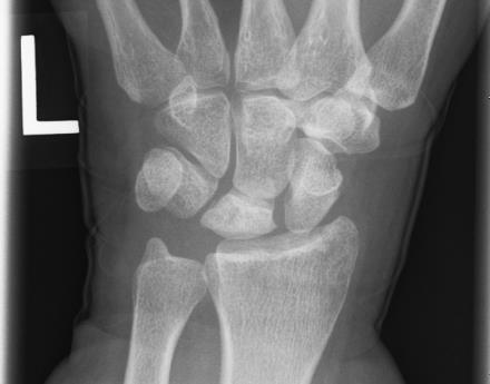 Röntgenfoto van de linkerhand met de ziekte van Kienbock