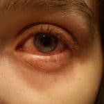 Rood oog (conjunctivitis): symptomen en behandeling