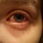 Rood oog (conjunctivitis)