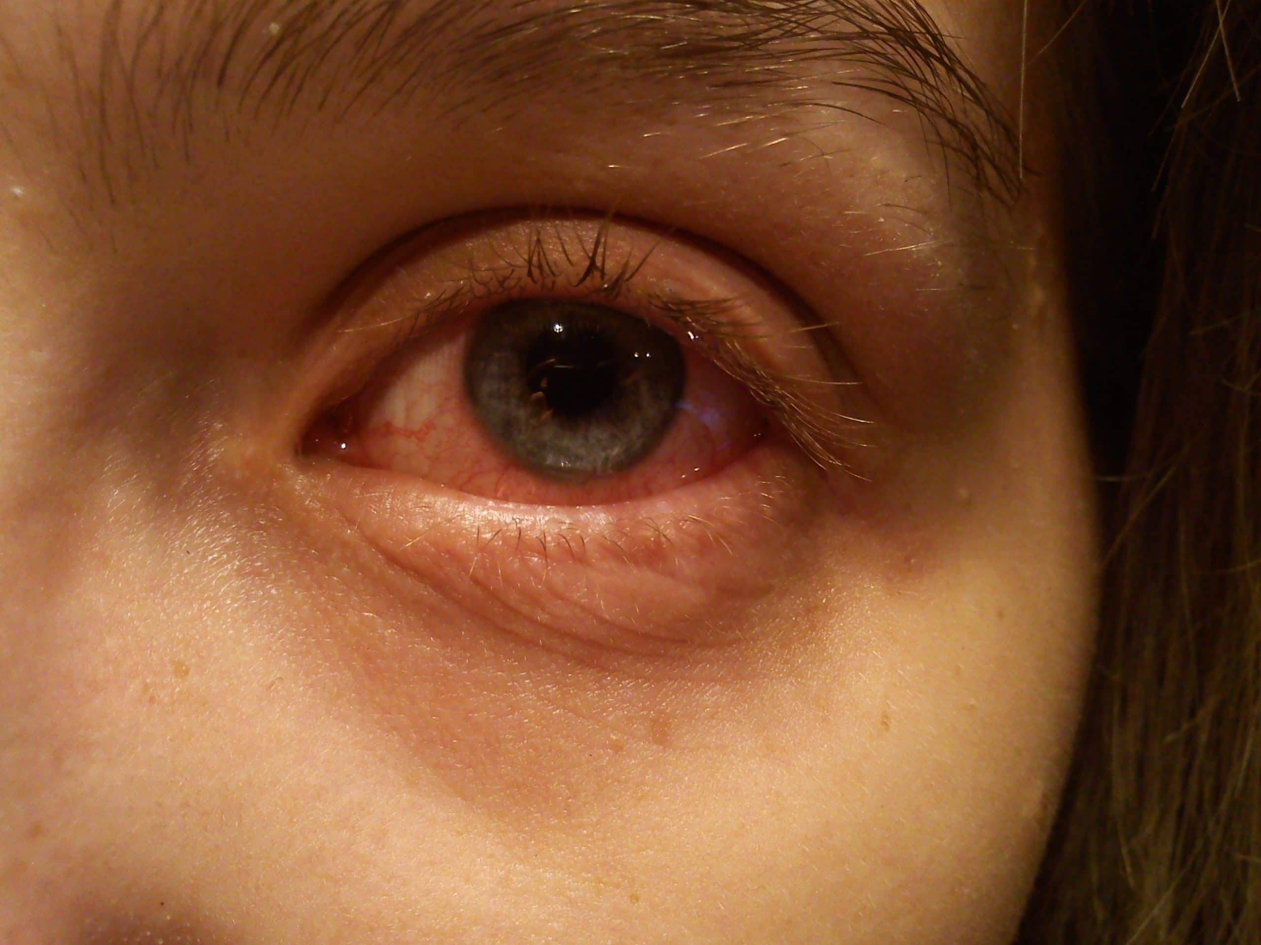 Rood oog (conjunctivitis)