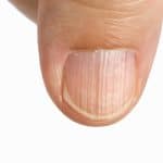 Geribbelde nagels: oorzaken van ribbels in de nagels
