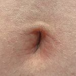 Stinkende navel: oorzaken van een navel die stinkt