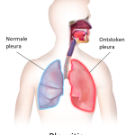 Pleuritis: symptomen, oorzaken en behandeling