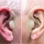 Rode-oorsyndroom: rode en branderige oren