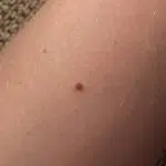 Een kersenwratje op een arm