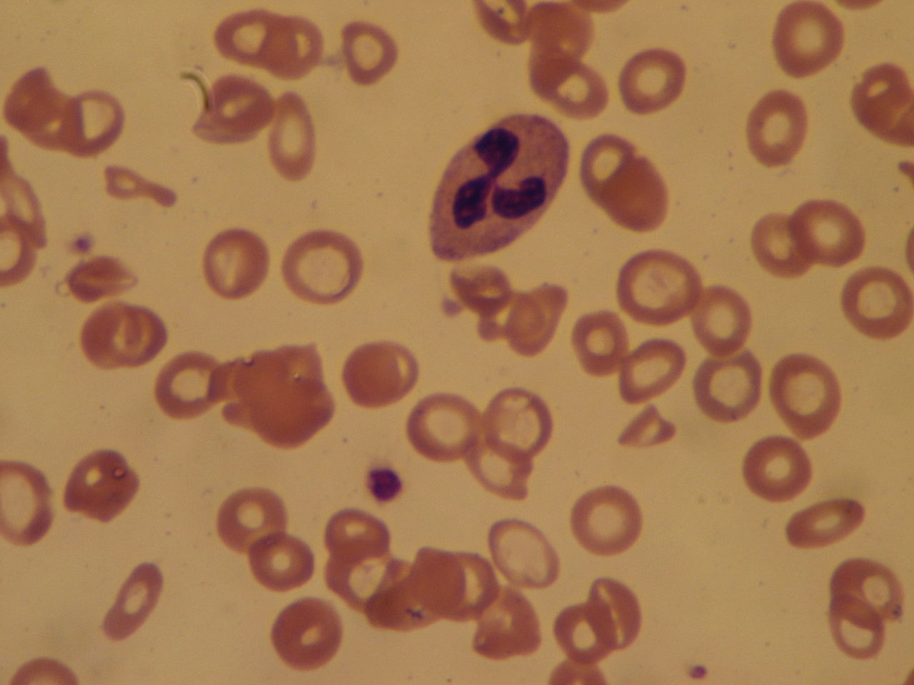 Bloedarmoede: afname van het aantal rode bloedcellen
