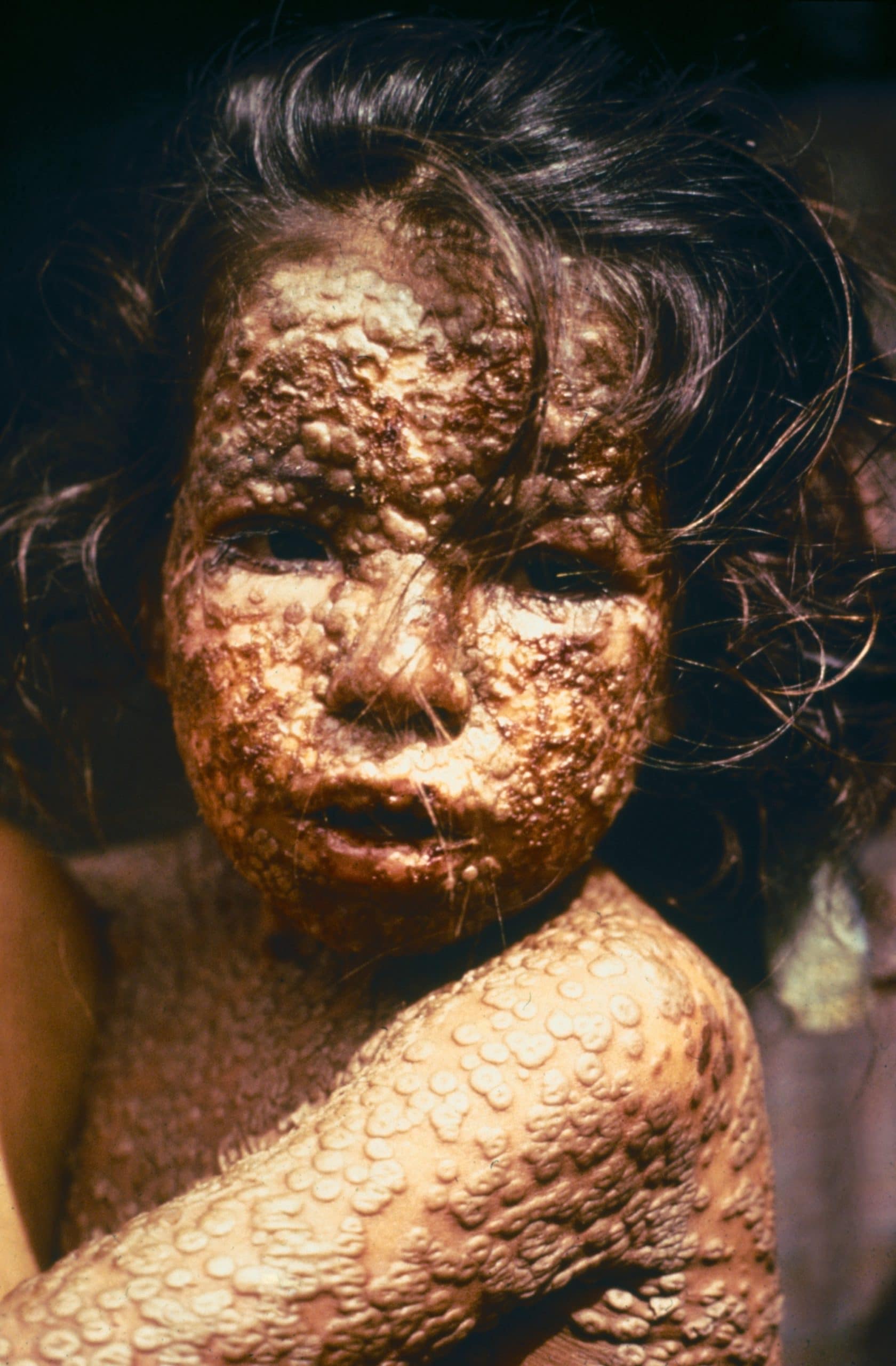 Een met de pokken besmet jong meisje uit Bangladesh (1973). In december 1977 werd het land 'pokkenvrij' verklaard door een commissie van de wereldgezondheidsorganisatie.