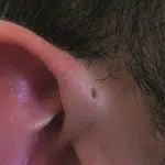 Klein gaatje vlak voor het oor: pre-auriculaire fistel