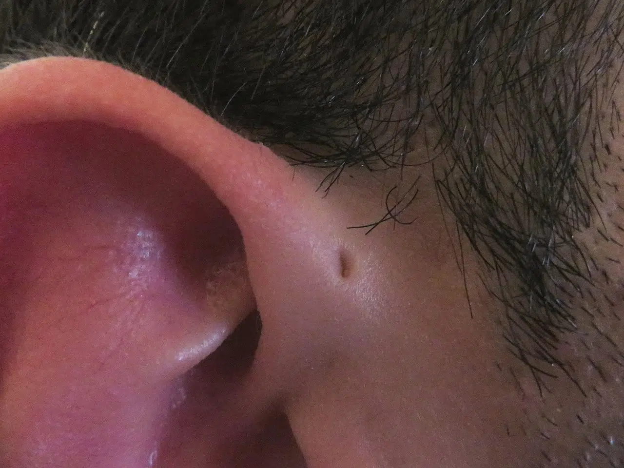 Pre-auriculaire fistel rechter oor