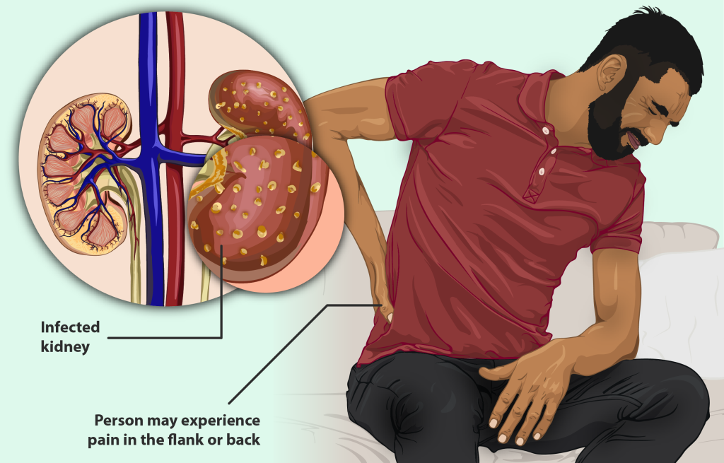 Afbeelding van een man die lijdt aan een nierinfectie of nierontsteking of pyelonefritis