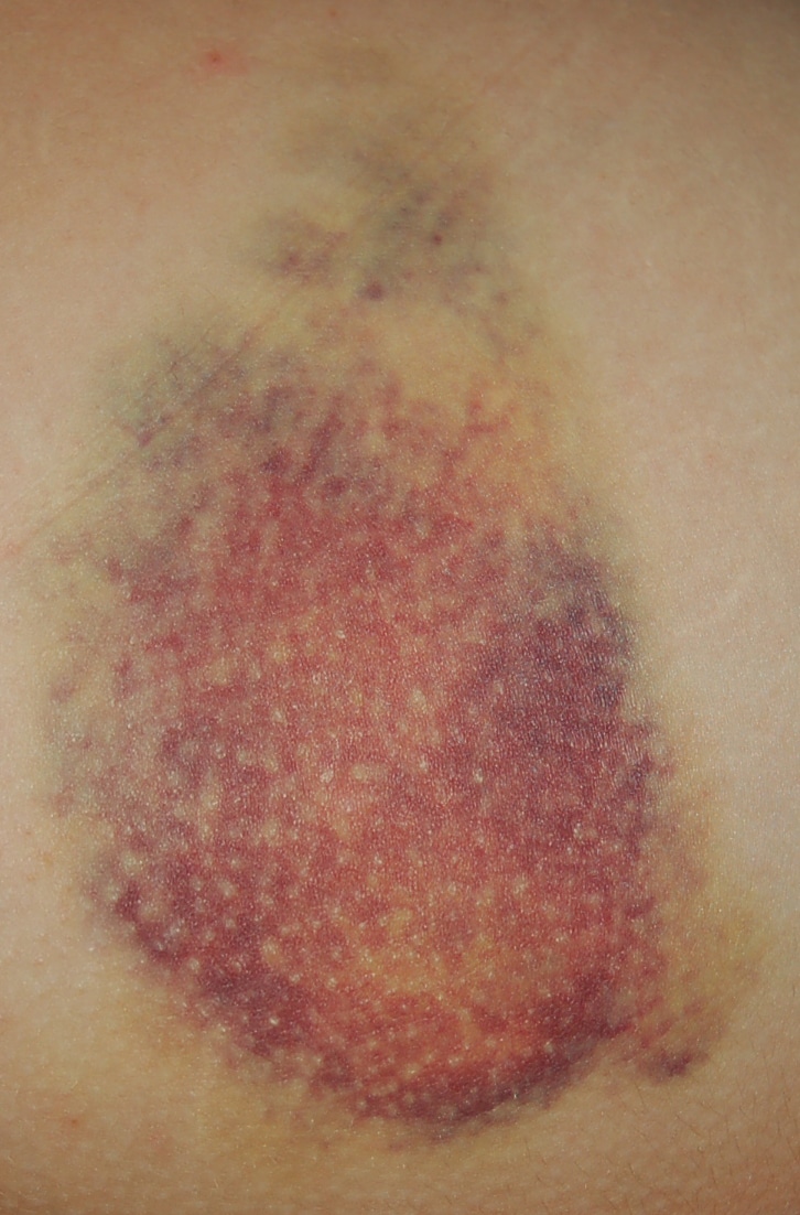 Een blauwe plek (ook wel een bloeduitstorting of hematoom genoemd)