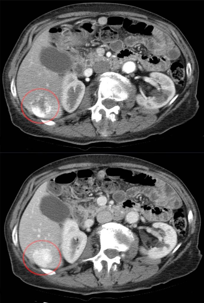 Leverhemangioom (CT-scan)
