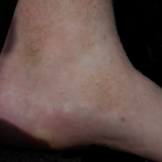 Ziekte van Schamberg of purpura pigmentosa progressiva (PPP)