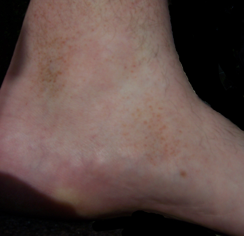 Roestkleurige vlekken die typisch zijn voor de ziekte van Schamberg op het linkeronderbeen en de linkervoet van een 26-jarige blanke man.