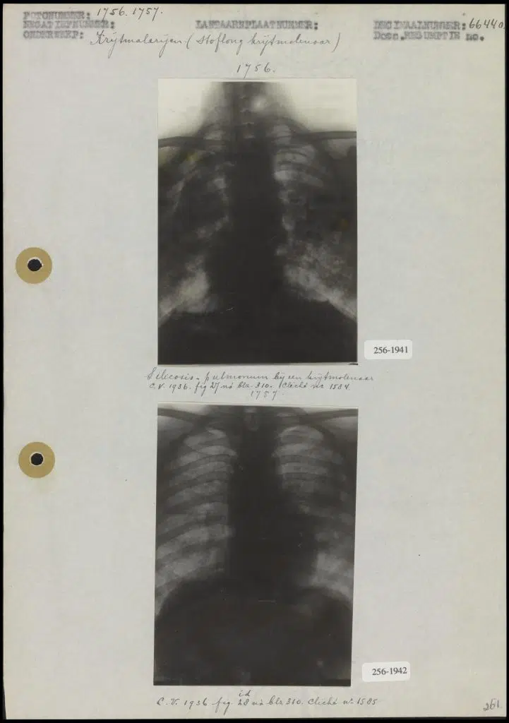 Silicosis-pulmonum stoflong bij een krijtmolenaar