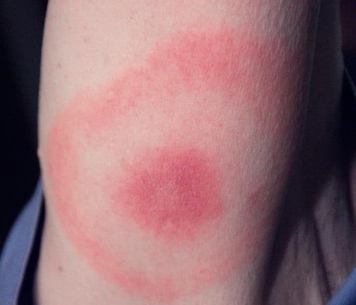 Erythema Migrans (EM)