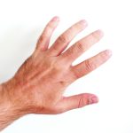Stinkende-vinger-syndroom: symptomen
