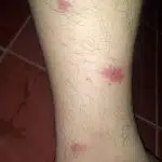 Muggenbulten op een been