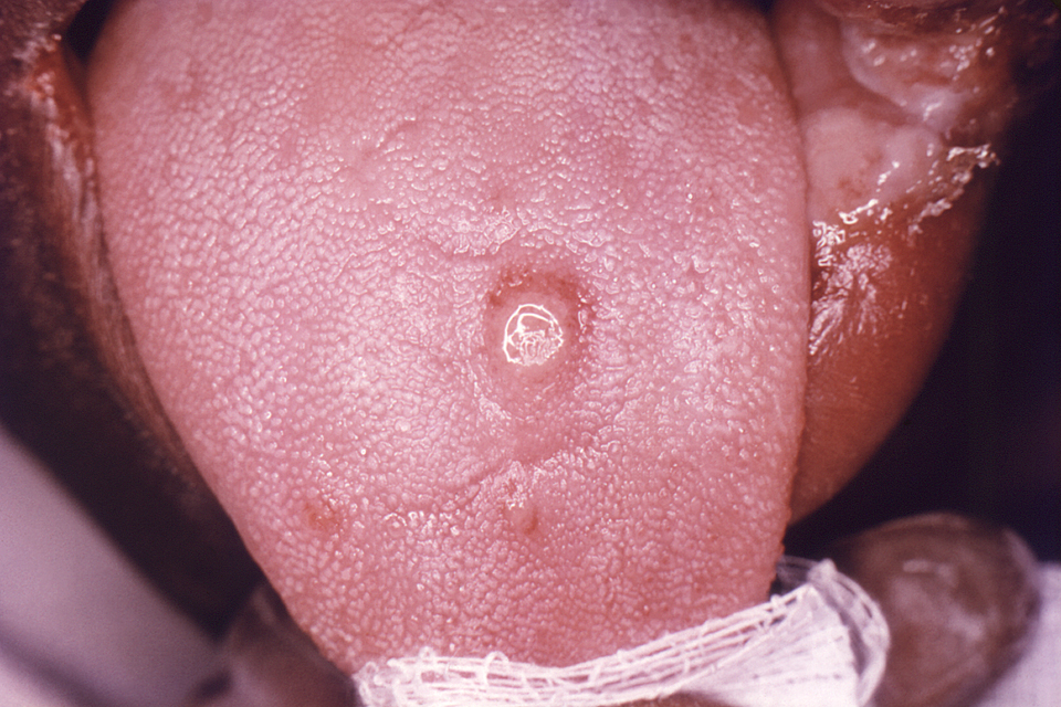 Primaire fase syfiliszweer (sjanker) op het oppervlak van een tong