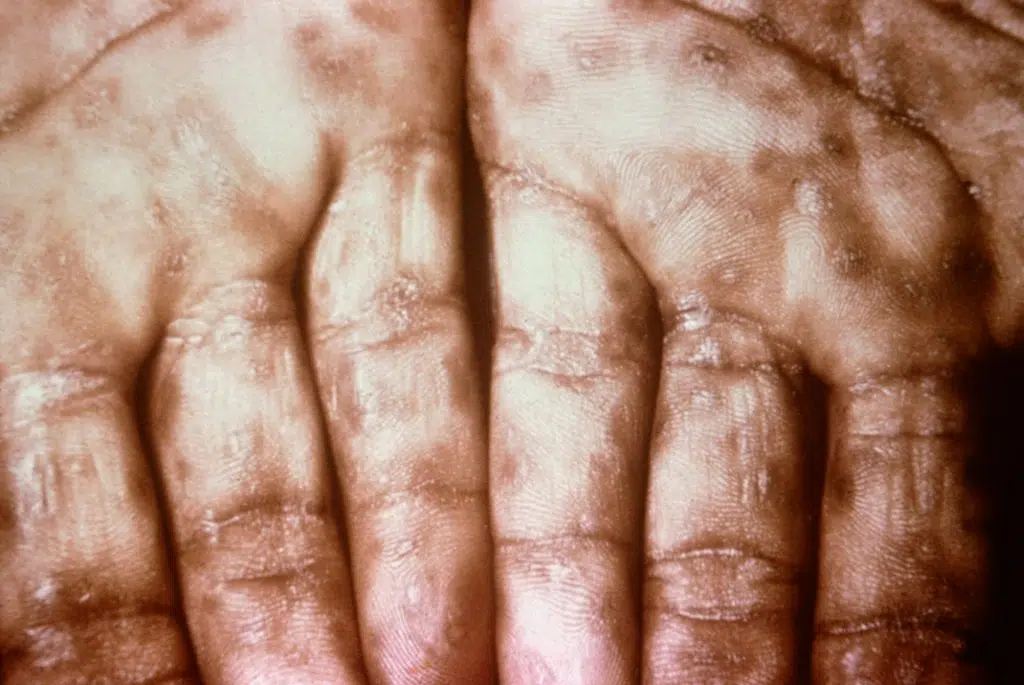 Typische presentatie van secundaire syfilis met uitslag op de handpalmen
