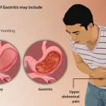 Afbeelding van een persoon die lijdt aan gastritis. De typische symptomen van gastritis zijn aangetoond.