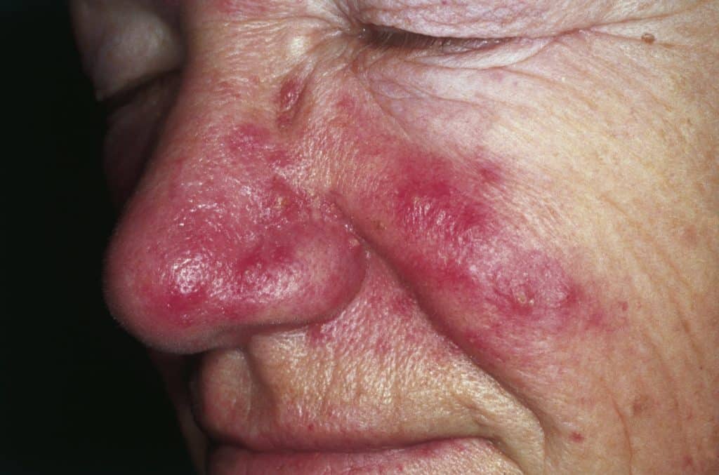 rosacea in het gelaat