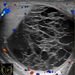 Scrotale echografie van een hematocele, een paar weken na verschijning