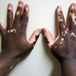Vitiligo: symptomen, oorzaak en behandeling