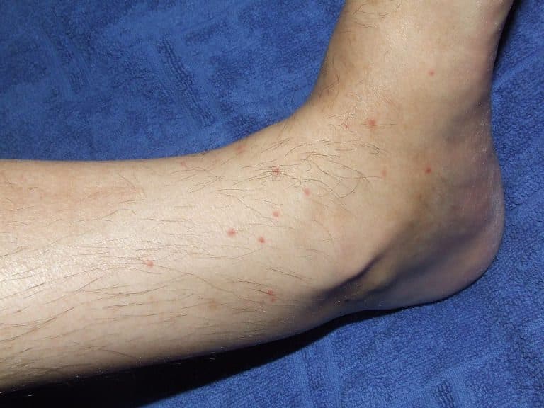 Vlooienbeet herkennen, symptomen en behandeling Mens & Gezondheid Vlooienbeet herkennen, symptomen en behandeling Mens & Gezondheid