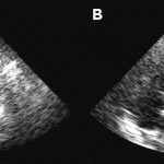 Takotsubo cardiomyopathie (A) Echocardiogram met dilatatie van de linker hartkamer in de acute fase (B) Resolutie van de linkerventrikelfunctie op herhaald echocardiogram zes dagen later