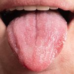 Pijn aan de tong: oorzaken tongpijn