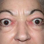 Uitpuilende ogen (proptosis)