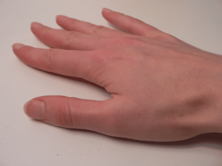 Schurft symptomen, oorzaak en behandeling Mens & Gezondheid