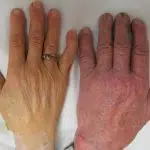 De hand van een persoon met ernstige bloedarmoede (links, met ring) in vergelijking met een zonder (rechts)