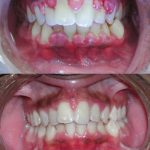 Gezwollen tandvlees: oorzaken, behandeling en kruiden