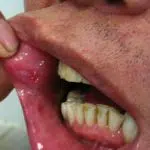 Zweertjes in de mond bij ziekte van Behçet