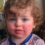 Baby met rode wangen: oorzaken