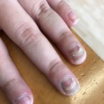 Loslatende nagel: oorzaken en behandeling