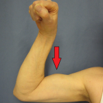 Gescheurde biceps: oorzaken, behandeling en herstel