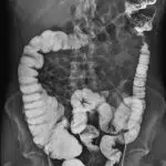 Röntgenfoto van dolichocolon bij een 48-jarige vrouw