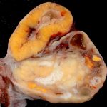 Menselijke eierstok met volledig ontwikkeld corpus luteum