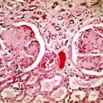 Bij diabetische nefropathie zie je twee glomeruli waarbij de lichtpaarse gebieden zonder cellen binnen de haarvaatjes wijzen op schadelijke ophopingen van mesangiale matrix