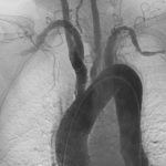 nker anterieure oblique angiografische afbeelding van Takayasu-arteritis waarop vernauwde gebieden in meerdere grote vaten te zien zijn.