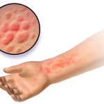 Een medische illustratie van urticaria op de handpalm, pols en onderarm