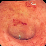 Endoscopisch beeld van een dikke darm getroffen door colitis ulcerosa. Het binnenoppervlak van de dikke darm is vlekkerig en op sommige plaatsen gebroken. Milde tot matige ziekte.