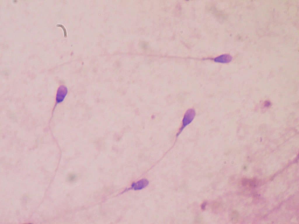 Antisperma-antilichamen (ASA): symptomen, oorzaak en behandeling