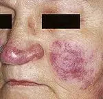 Cutane laesies van sarcoidose (lupus pernio). Rode tot paarse verharde plaques en nodules die de neus en wangen aantasten.
