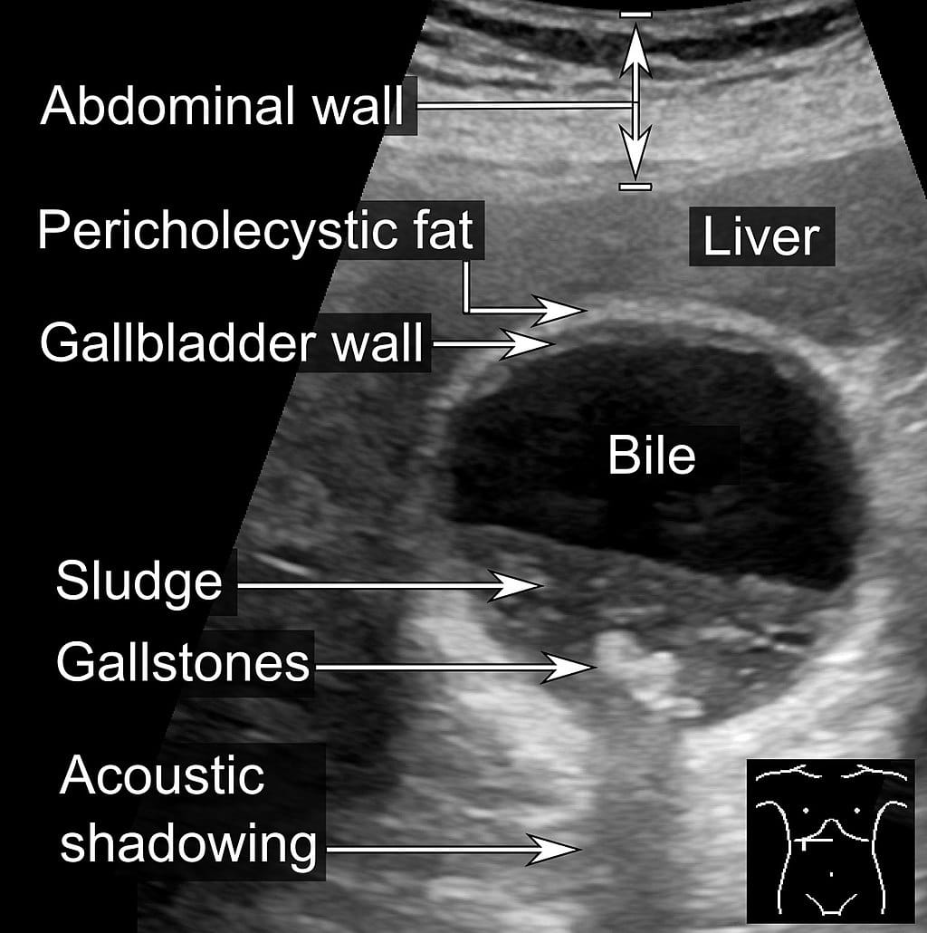 Echografie van de galblaas met labels die galblaasslib, galstenen, galvloeistof, galblaaswand en akoestische schaduw aanduiden, samen met omliggende structuren zoals lever en buikwand.