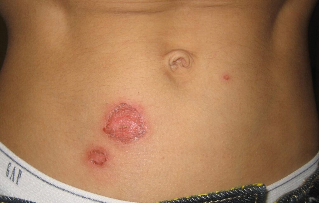 Huid van de onderbuik met twee ronde, rode plekken door krentenbaard (impetigo), met oppervlakkige erosie en korstvorming nabij de navel.